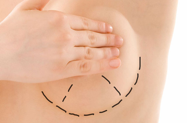 мифы о пластике груди: о шрамах